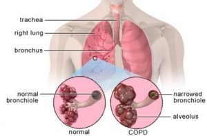 copd patient